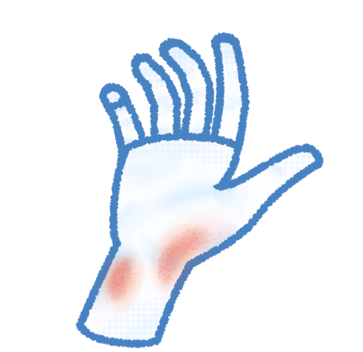 A blue and white toned drawing of a hand and wrist with friction burn on the wrist.